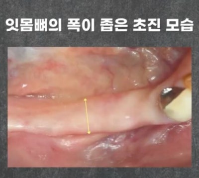 임플란트 전문가 변성만 원장 TV 출연 - 통증 줄인 무절개 임플란트 사진 3