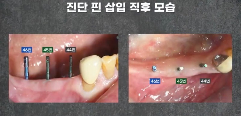 임플란트 전문가 변성만 원장 TV 출연 - 통증 줄인 무절개 임플란트 사진 4
