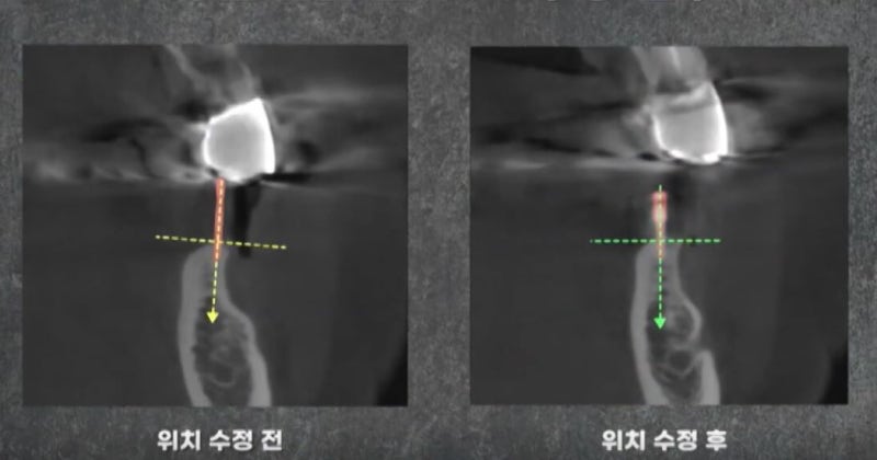 임플란트 전문가 변성만 원장 TV 출연 - 통증 줄인 무절개 임플란트 사진 7