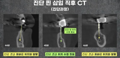 임플란트 전문가 변성만 원장 TV 출연 - 통증 줄인 무절개 임플란트 사진 6