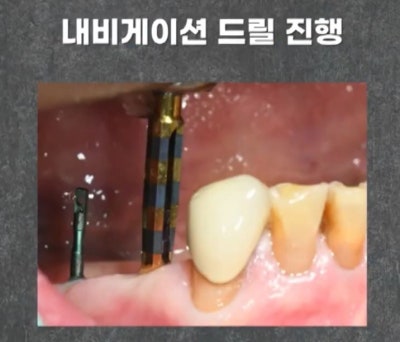 임플란트 전문가 변성만 원장 TV 출연 - 통증 줄인 무절개 임플란트 사진 8