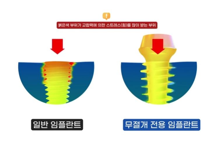 통증 줄이고 회복 빠른 하루플란트치과 CLS 무절개 임플란트 사진 5