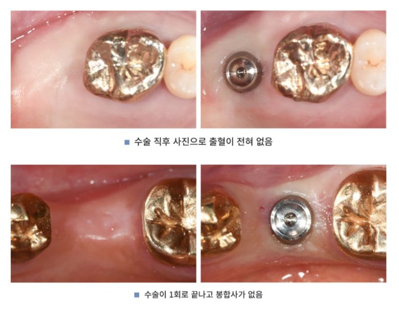 통증 줄이고 회복 빠른 하루플란트치과 CLS 무절개 임플란트 사진 3