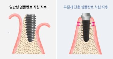 통증 줄이고 회복 빠른 하루플란트치과 CLS 무절개 임플란트 사진 8