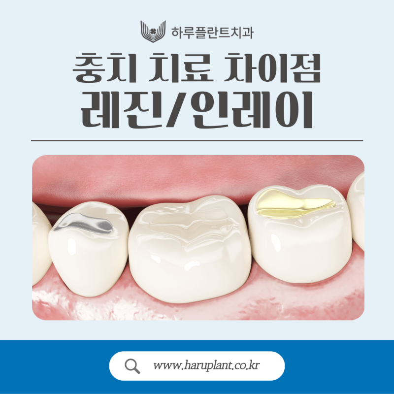 강남충치치료 레진 인레이 차이는?