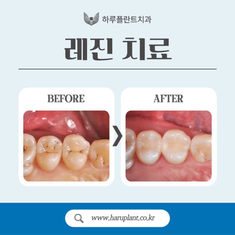 강남충치치료 레진 인레이 차이는? 사진 3