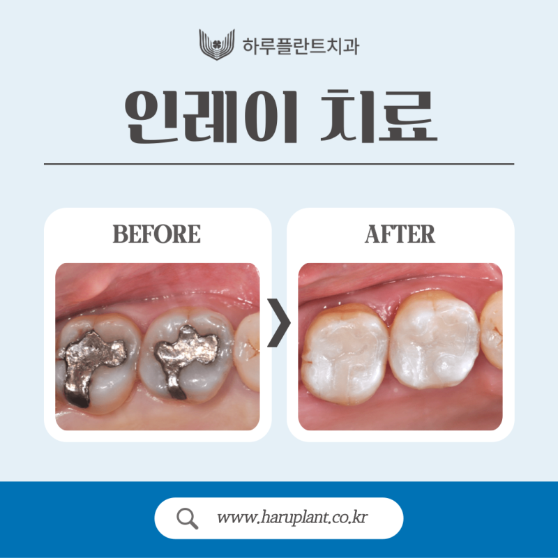 강남충치치료 레진 인레이 차이는? 사진 4