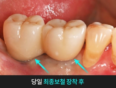 치과당일치료 하루플란트치과의 혁신적인 하루완성 클리닉 사진 5