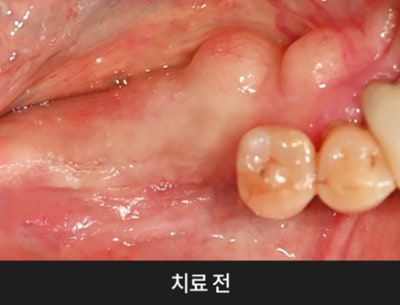치과당일치료 하루플란트치과의 혁신적인 하루완성 클리닉 사진 2