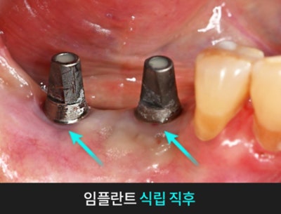 치과당일치료 하루플란트치과의 혁신적인 하루완성 클리닉 사진 3