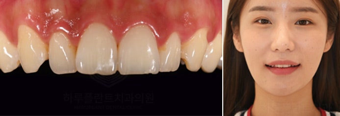 치과당일치료 하루플란트치과의 혁신적인 하루완성 클리닉 사진 6