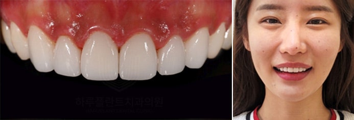 치과당일치료 하루플란트치과의 혁신적인 하루완성 클리닉 사진 7