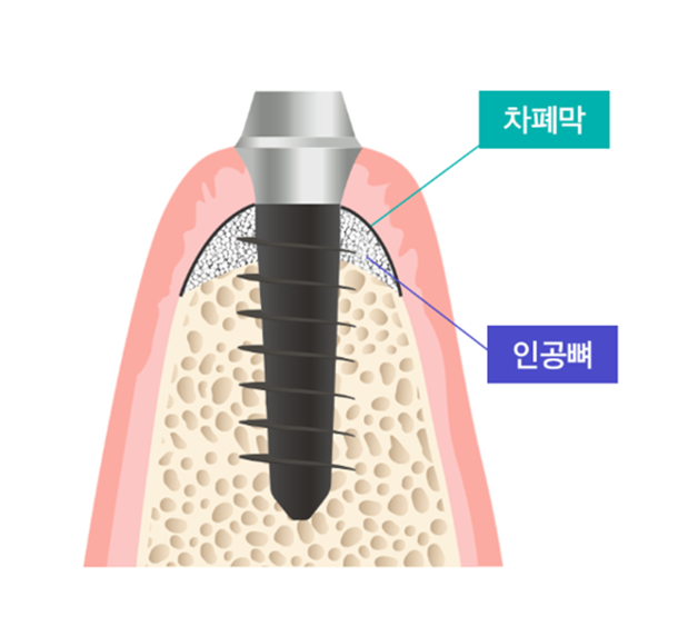 임플란트 뼈이식 수술 후기와 진행과정 공개 사진 6
