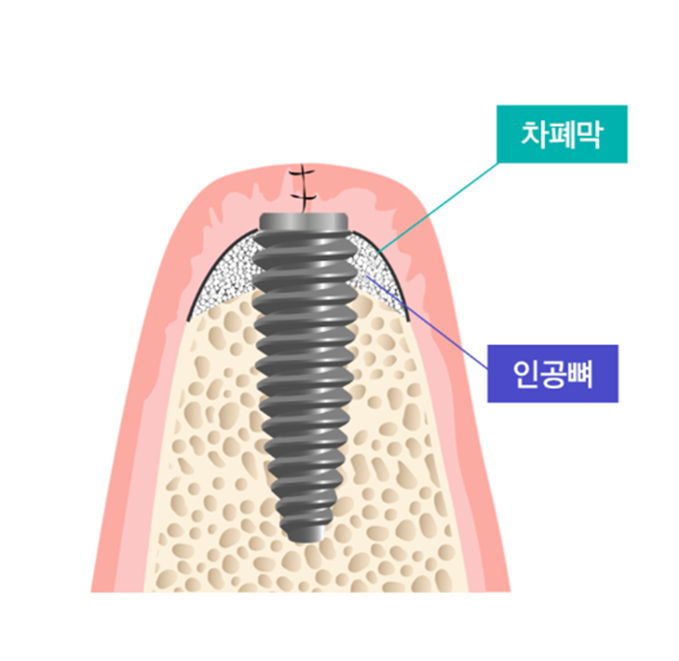 임플란트 뼈이식 수술 후기와 진행과정 공개 사진 4