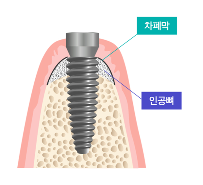 임플란트 뼈이식 수술 후기와 진행과정 공개 사진 2