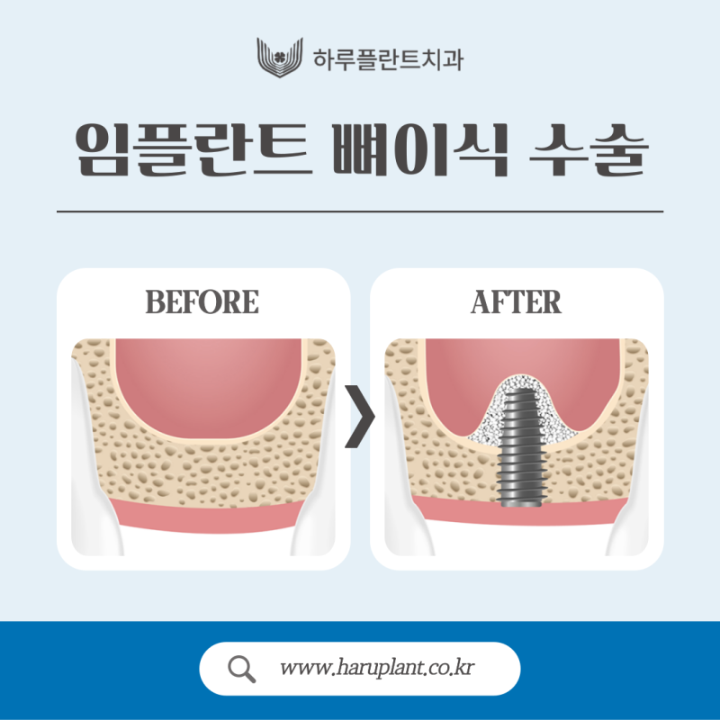 임플란트 뼈이식 수술 후기와 진행과정 공개