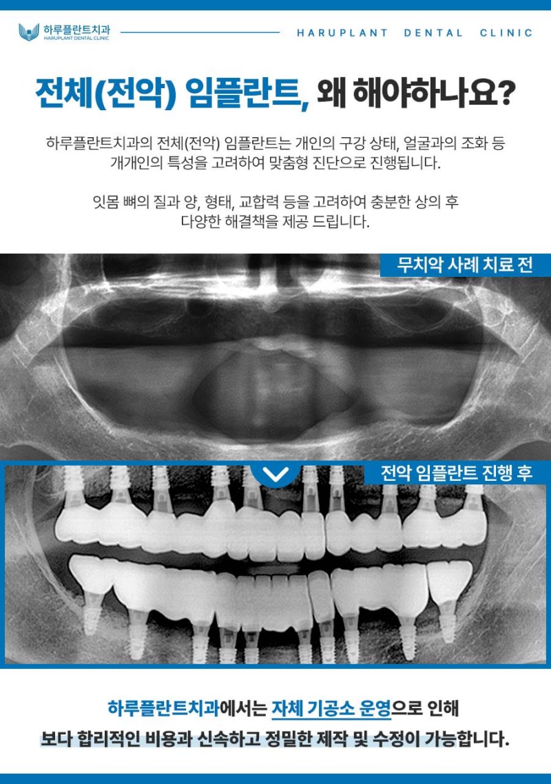 전악 임플란트 비용, 저희는 이 3가지로 비용을 줄였습니다. 사진 4