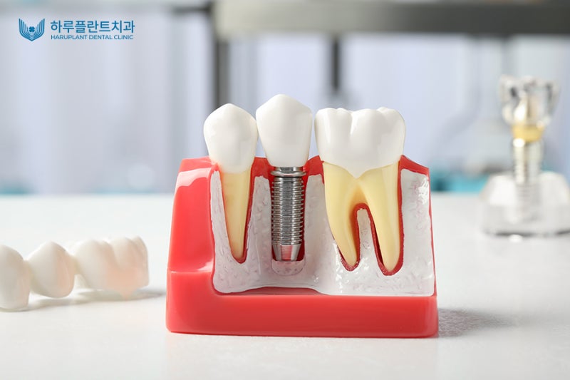 강남 원데이 임플란트, 하루만에 가능한 방법 알려드립니다 사진 4