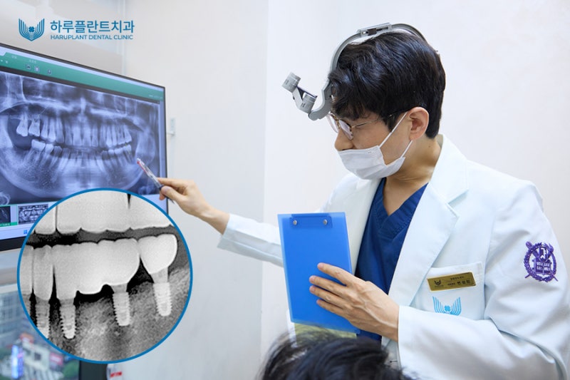 완전틀니가격? 임플란트보다 틀니가 비싼 이유 사진 4