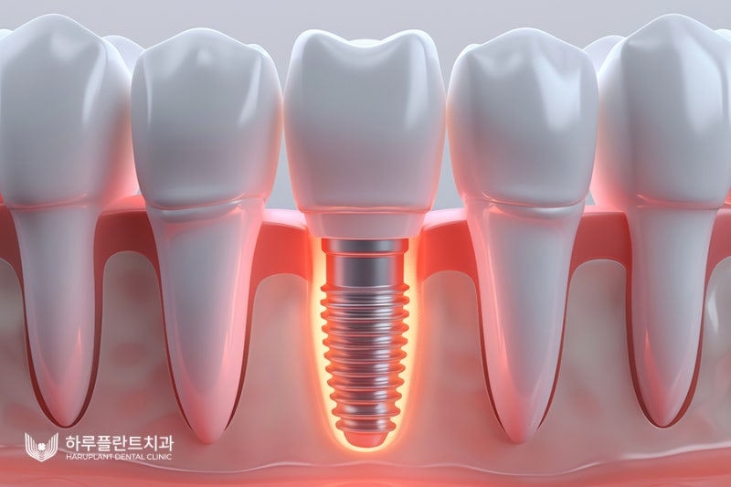 임플란트 수명 오래 유지하려면 이렇게 하세요 사진 3