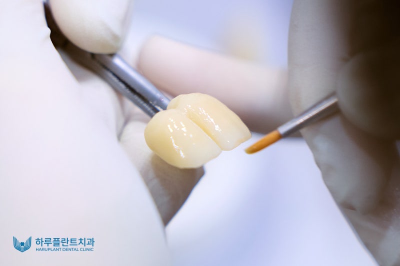 하루 만에 완성하는 자연스러운 심미치료, 하루네이트 사진 4