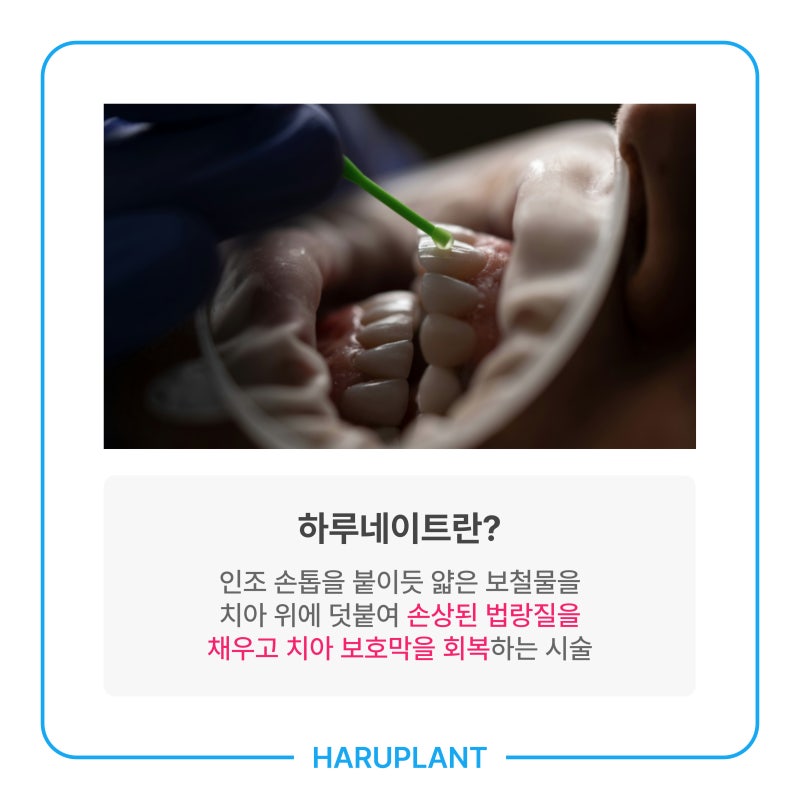 이 시린 이유, 시린 이 치료법 하루네이트로 회복하세요 사진 4