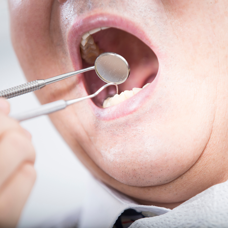 하루플란트가 알려주는 임플란트 후 음주! 술은 언제부터 마셔도 될까요? 사진 4