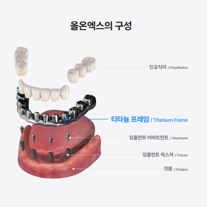 전체 임플란트가 부담된다면 이건 어떠세요? 하루플란트의 실속있는 올온엑스 임플란트 솔루션! 사진 4
