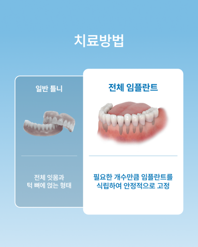 틀니 불편하다면? 꼭 알아야 할 전체 임플란트와 틀니 차이점, 강남 임플란트 하루플란트치과에서 알려드립니다 사진 2