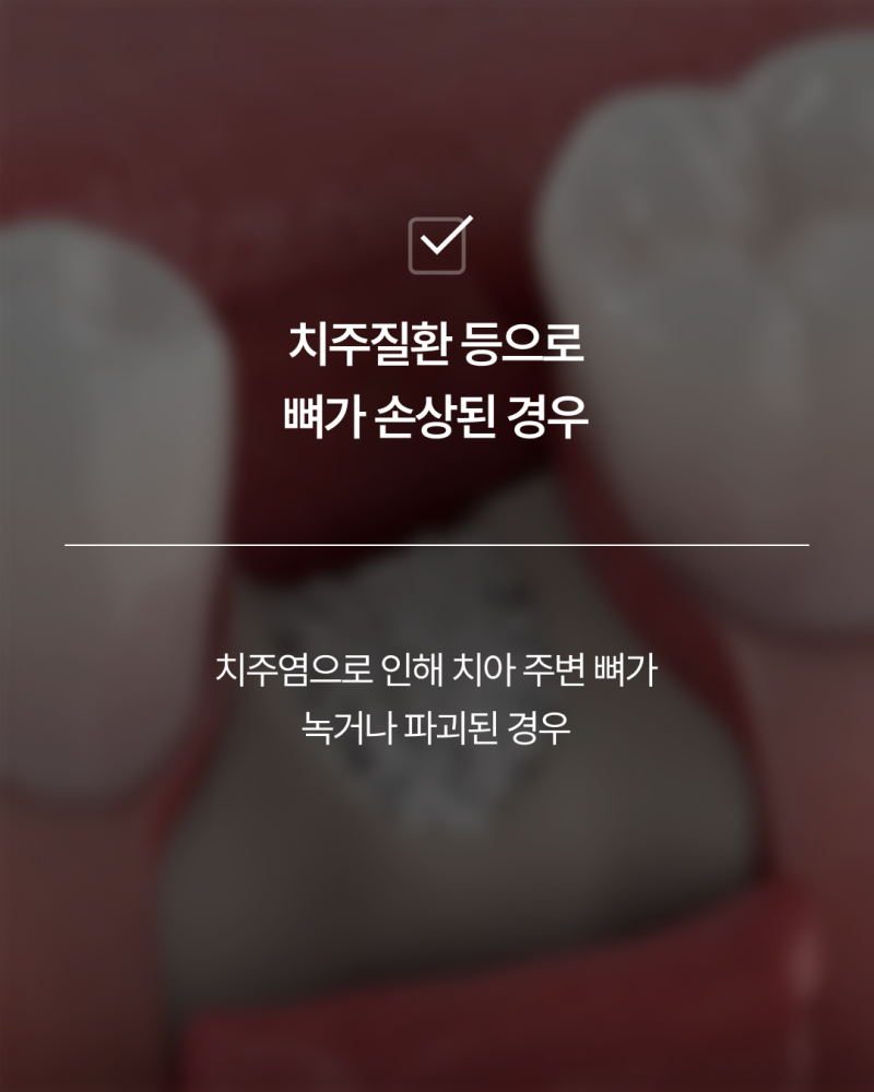 임플란트뼈이식, 반드시 필요할까요? 강남임플란트 하루플란트에서 기준을 확인하세요 사진 6