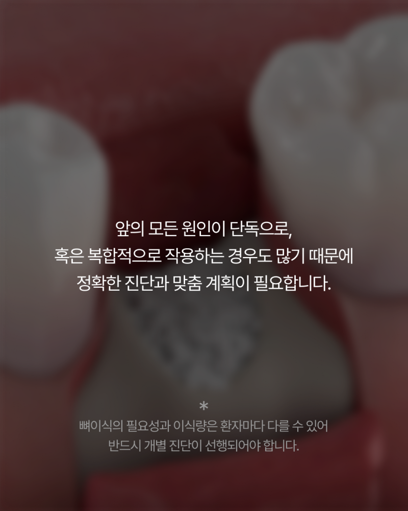 임플란트뼈이식, 반드시 필요할까요? 강남임플란트 하루플란트에서 기준을 확인하세요 사진 9