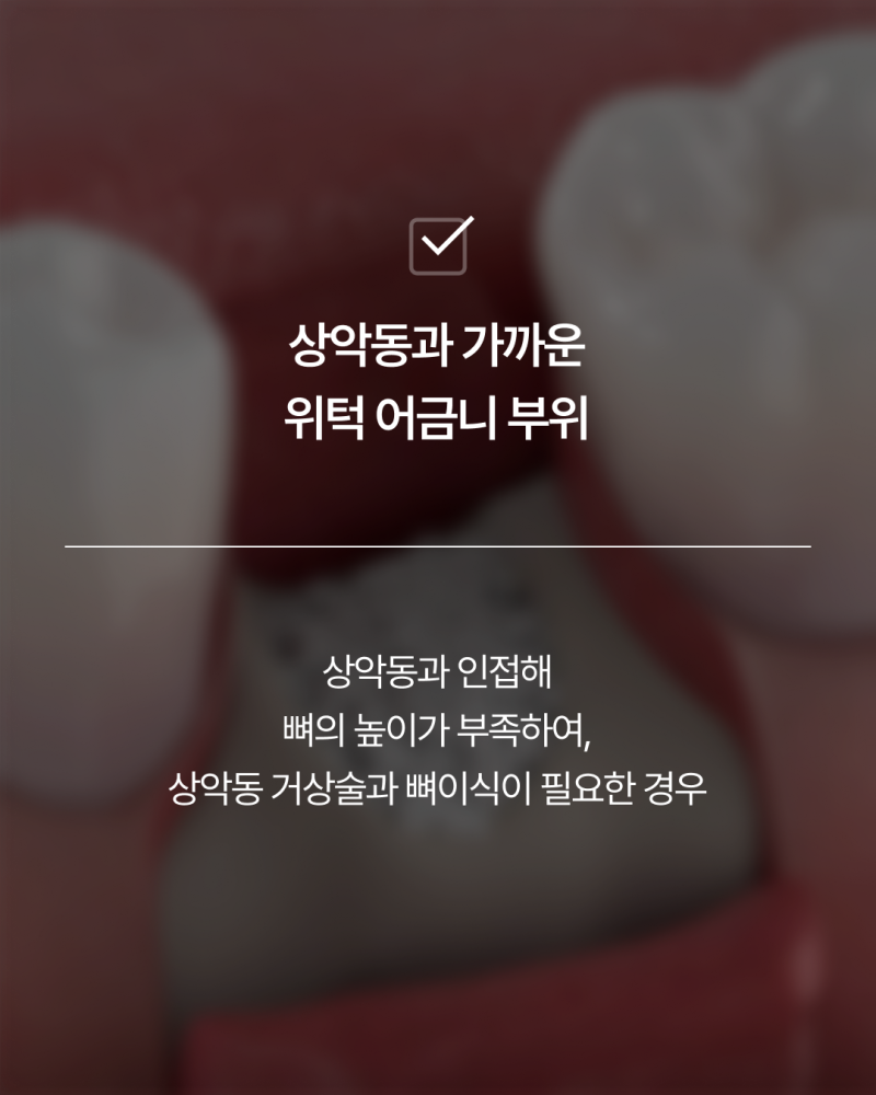 임플란트뼈이식, 반드시 필요할까요? 강남임플란트 하루플란트에서 기준을 확인하세요 사진 8