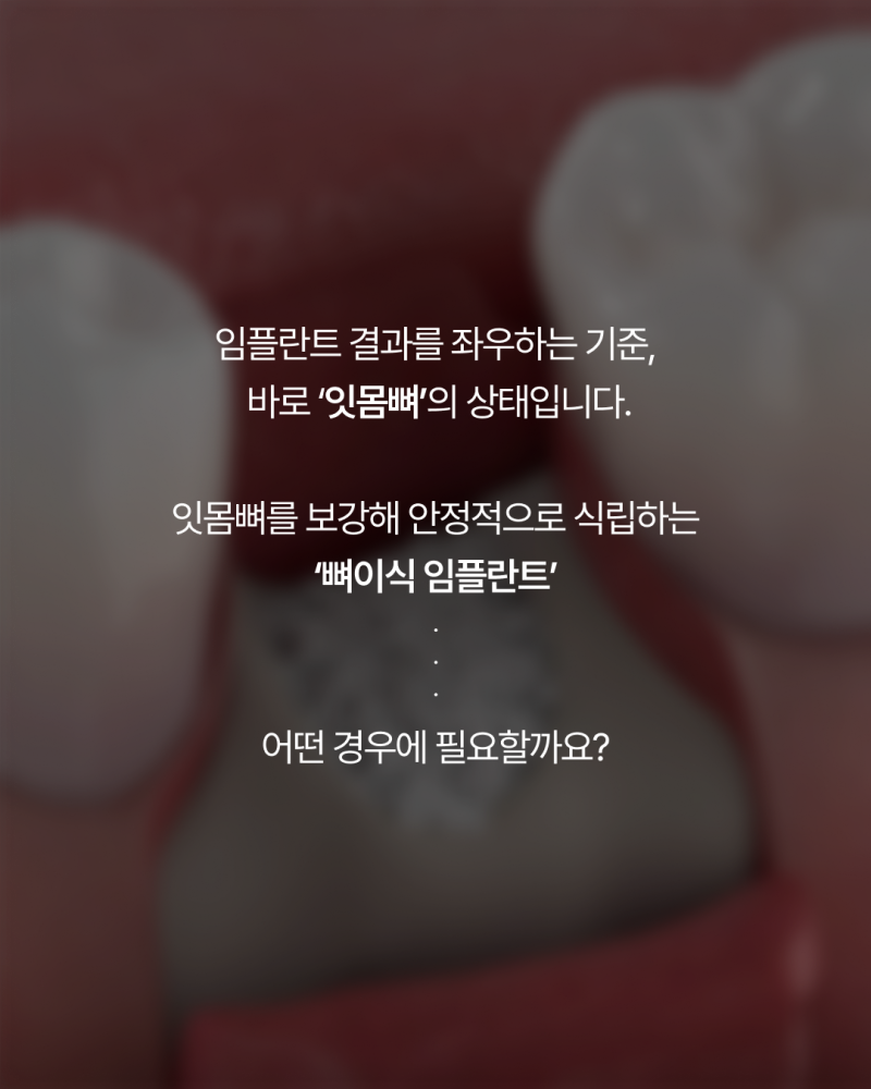임플란트뼈이식, 반드시 필요할까요? 강남임플란트 하루플란트에서 기준을 확인하세요