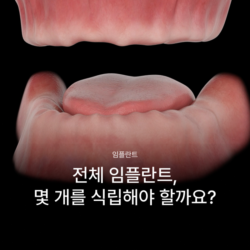 전체 임플란트 몇개나 식립해야 할까요? 나에게 맞는 식립 개수에 따라 무치악임플란트 종류와 비용이 달라집니다