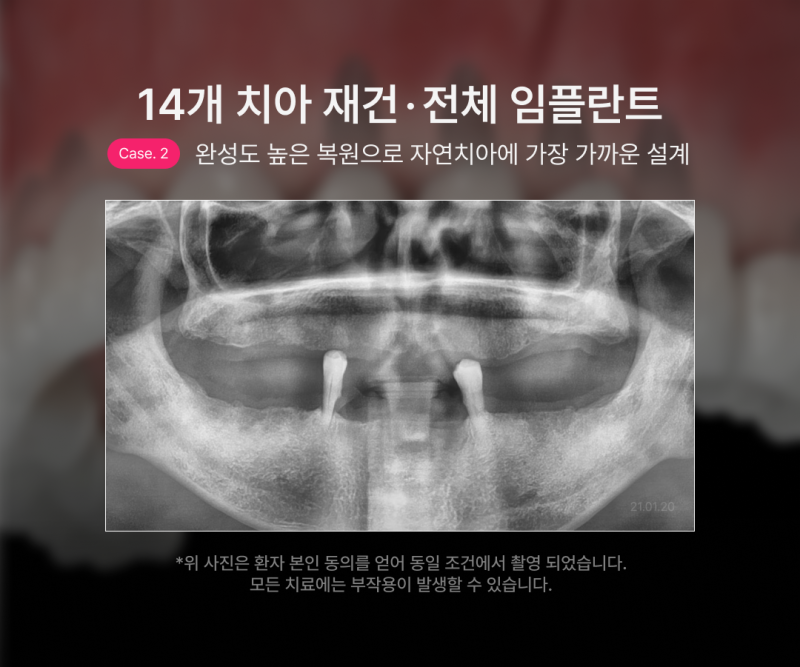 전체 임플란트 몇개나 식립해야 할까요? 나에게 맞는 식립 개수에 따라 무치악임플란트 종류와 비용이 달라집니다 사진 7