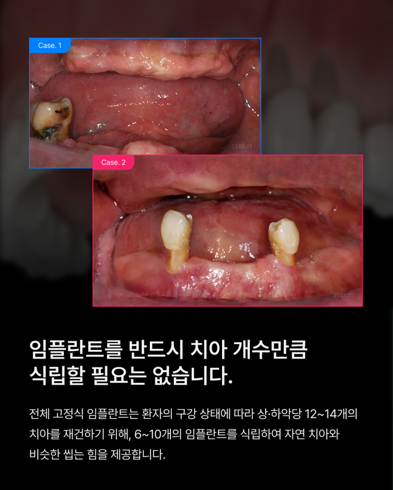 전체 임플란트 몇개나 식립해야 할까요? 나에게 맞는 식립 개수에 따라 무치악임플란트 종류와 비용이 달라집니다 사진 2