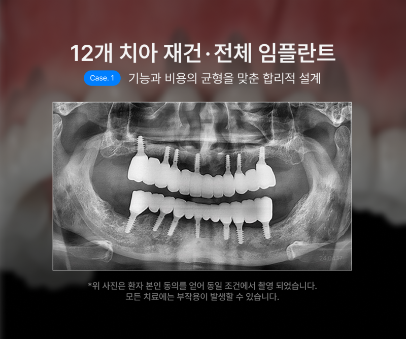 전체 임플란트 몇개나 식립해야 할까요? 나에게 맞는 식립 개수에 따라 무치악임플란트 종류와 비용이 달라집니다 사진 6