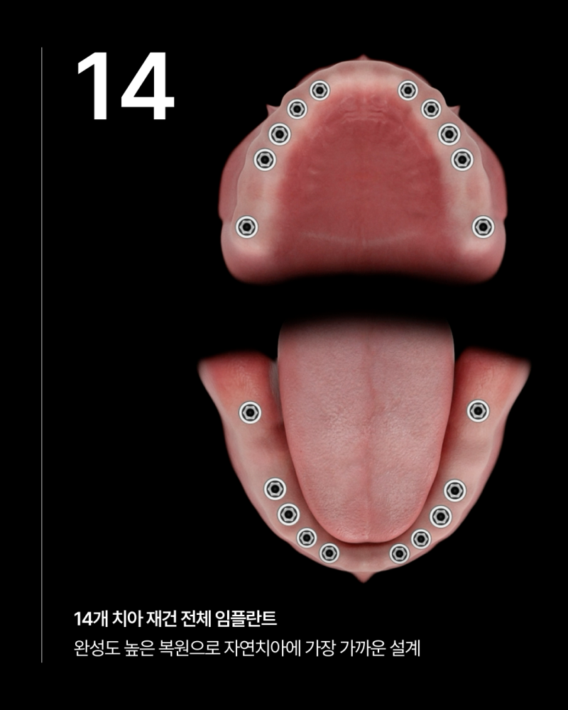 전체 임플란트 몇개나 식립해야 할까요? 나에게 맞는 식립 개수에 따라 무치악임플란트 종류와 비용이 달라집니다 사진 4