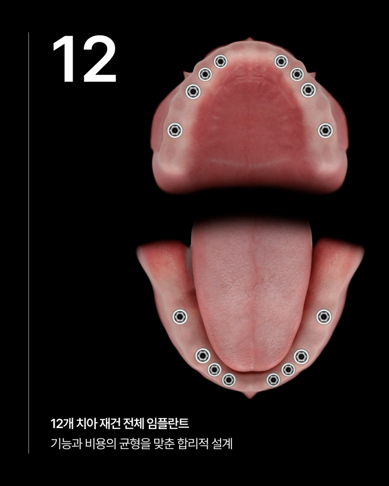 전체 임플란트 몇개나 식립해야 할까요? 나에게 맞는 식립 개수에 따라 무치악임플란트 종류와 비용이 달라집니다 사진 3