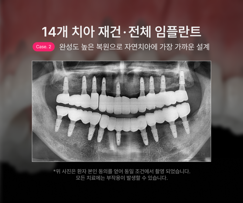전체 임플란트 몇개나 식립해야 할까요? 나에게 맞는 식립 개수에 따라 무치악임플란트 종류와 비용이 달라집니다 사진 8