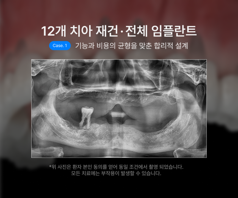 전체 임플란트 몇개나 식립해야 할까요? 나에게 맞는 식립 개수에 따라 무치악임플란트 종류와 비용이 달라집니다