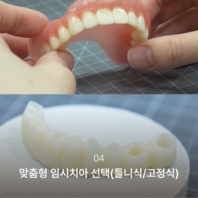 임플란트본뜨기과정이 달라진 이유, 결과의 차이를 만드는 강남역 하루플란트치과의 전체임플란트과정 사진 5