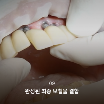 임플란트본뜨기과정이 달라진 이유, 결과의 차이를 만드는 강남역 하루플란트치과의 전체임플란트과정 사진 10