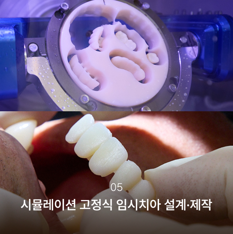 임플란트본뜨기과정이 달라진 이유, 결과의 차이를 만드는 강남역 하루플란트치과의 전체임플란트과정 사진 6