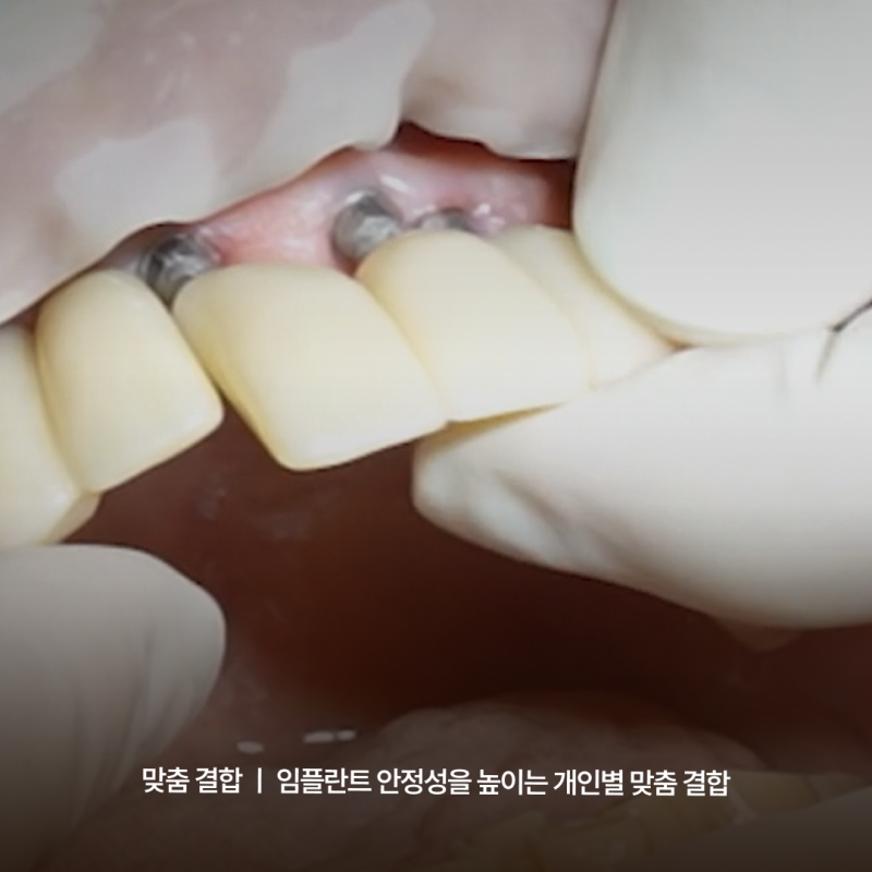강남역임플란트치과추천 기준, 하루플란트치과 맞춤형 진료 시스템에서 확인하세요 사진 7