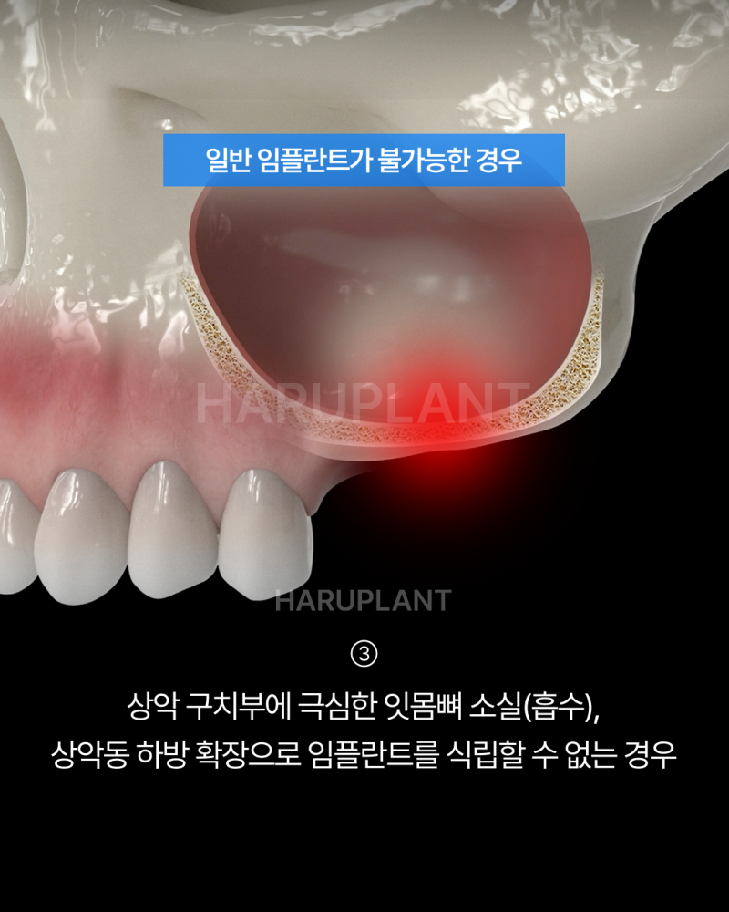 올온엑스 임플란트, 전악 임플란트가 어렵다고 들은 경우에도 고려할 수 있는 이유는? 사진 5