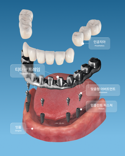 올온엑스 임플란트, 전악 임플란트가 어렵다고 들은 경우에도 고려할 수 있는 이유는? 사진 9