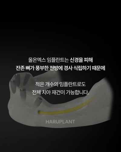 올온엑스 임플란트, 전악 임플란트가 어렵다고 들은 경우에도 고려할 수 있는 이유는? 사진 7