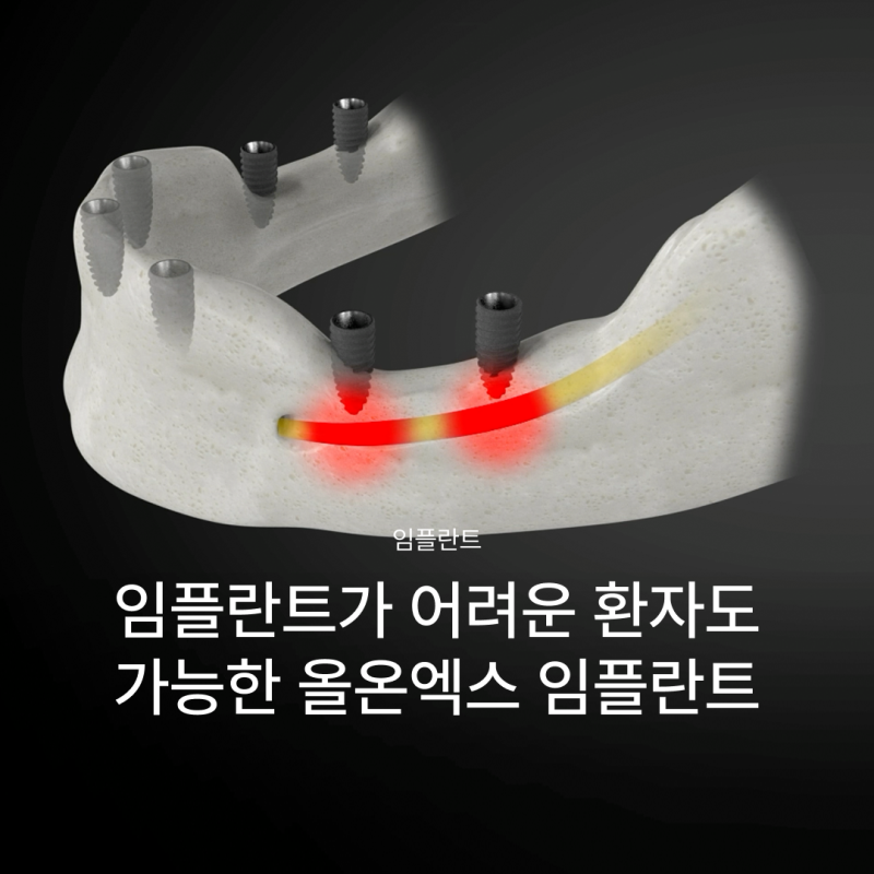 올온엑스 임플란트, 전악 임플란트가 어렵다고 들은 경우에도 고려할 수 있는 이유는?