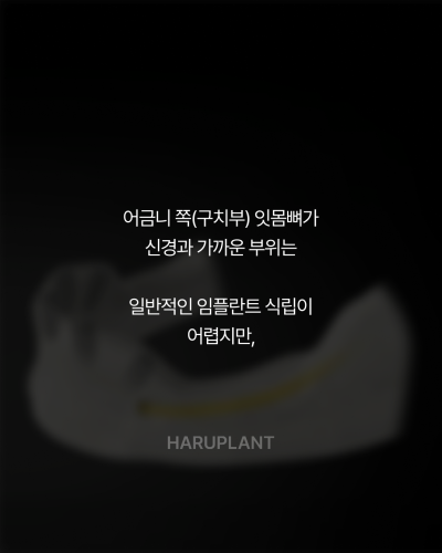 올온엑스 임플란트, 전악 임플란트가 어렵다고 들은 경우에도 고려할 수 있는 이유는? 사진 6